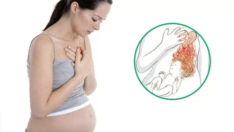 Остеохондроз у беременных. Остеохондроз шейного отдела у беременных. Остеохондроз при беременности симптомы. Хондроз и беременность.