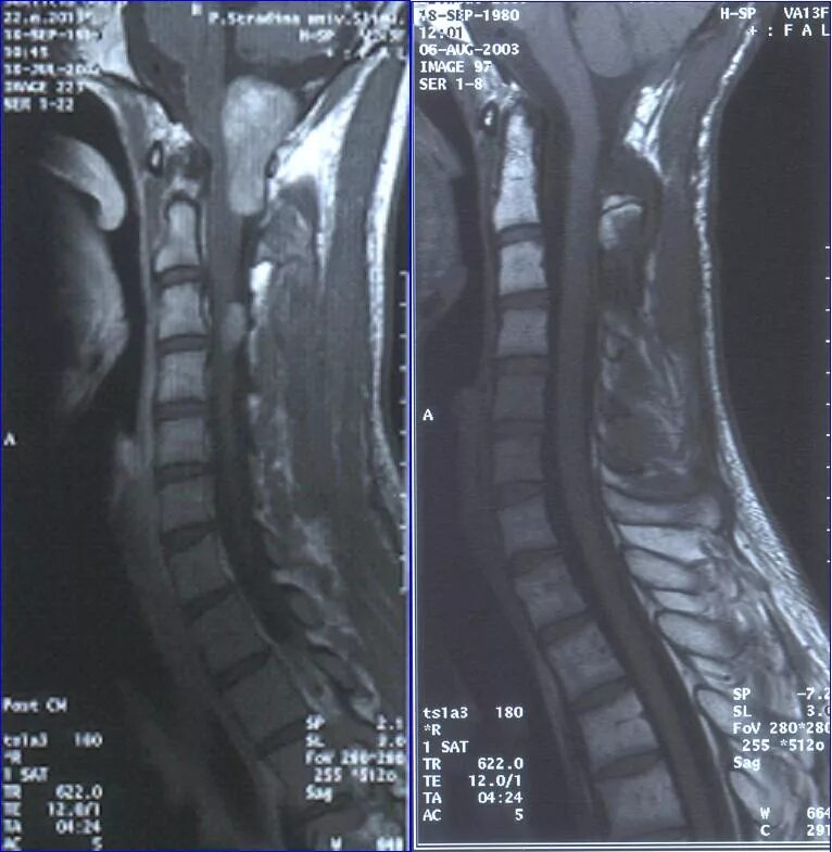 Опухоли спинного мозга шейного отдела симптомы. Интрамуральная опухоль спинного мозга. Опухоль спинного мозга с1 с2. Метастатические опухоли спинного мозга. Отек позвоночника после операции