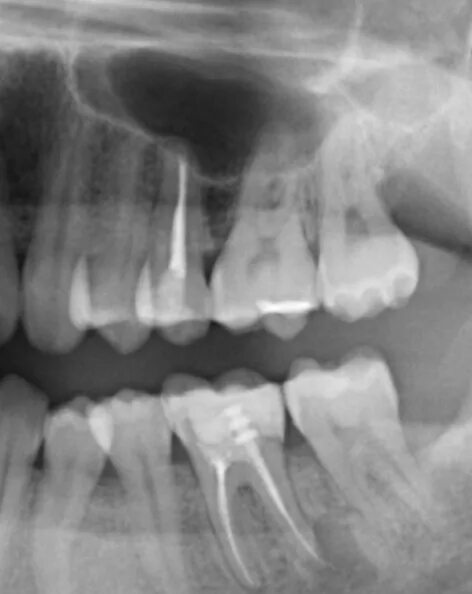 Снимок зубов видное. Ретенционная киста зуба рентген. Киста зуба на рентген снимке. Киста верхнего зуба рентген.