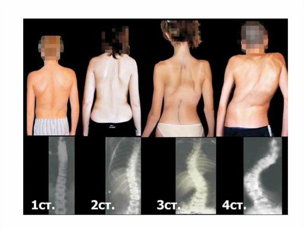 Остеопатический кифосколиоз. Можно исправить сколиоз 1 степени. Сколиоз 1 степени угол искривления. Сколиоз позвоночника 2 степени реберный горб. Корсет шено сколиоз 2 степени.