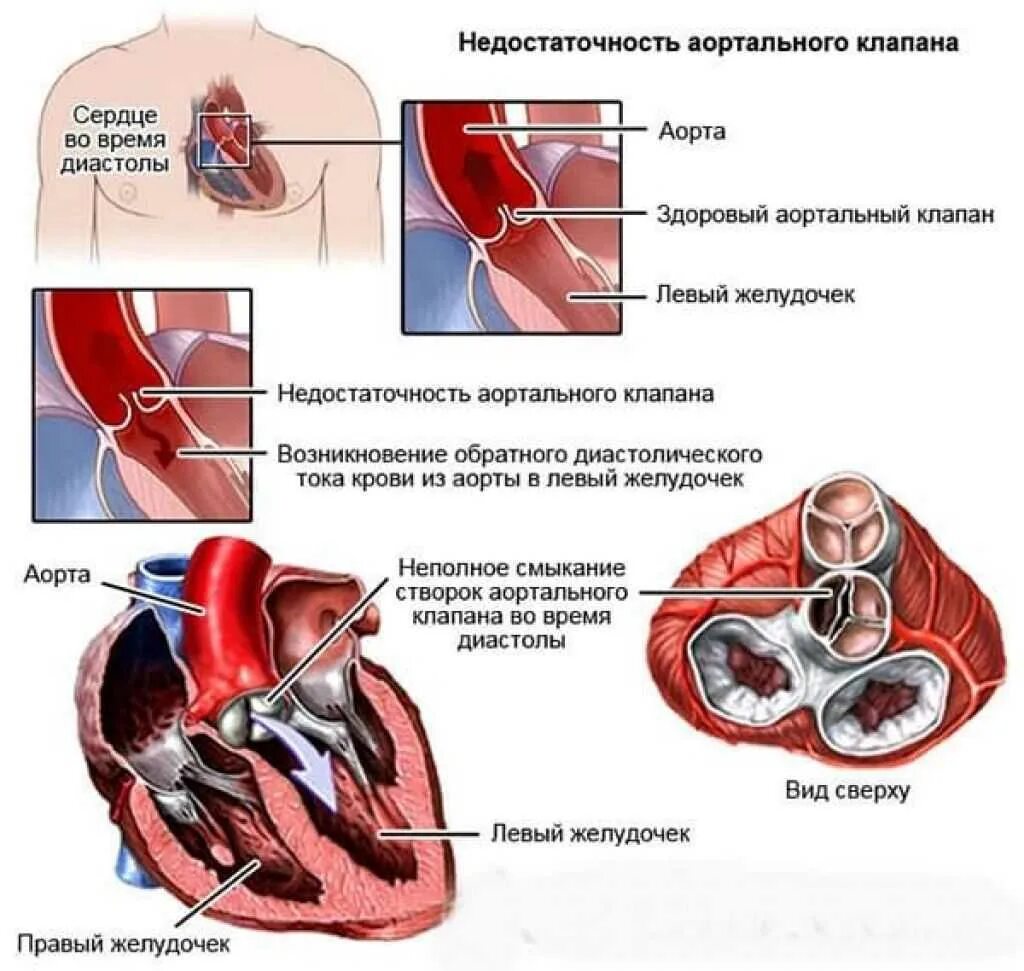 Как клапан делает операция. Аортальная клапанная недостаточность. Недостаточность аортального клапана. Проявления недостаточности аортального клапана. Аортальный клапан первой степени.