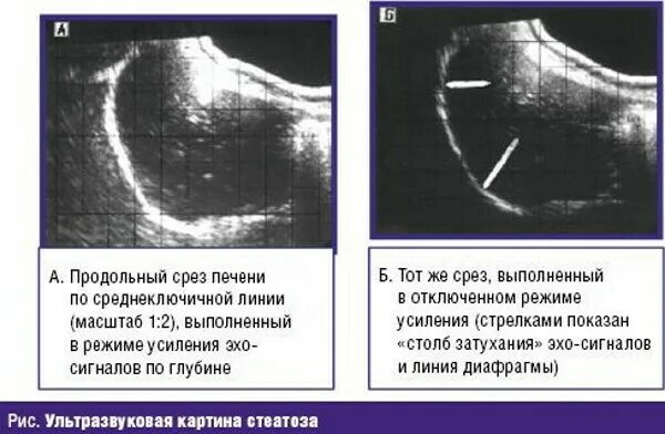 Диффузные изменения печени жировой гепатоз что это. Жировая инфильтрация печени на УЗИ. УЗИ признаки стеатоза печени.