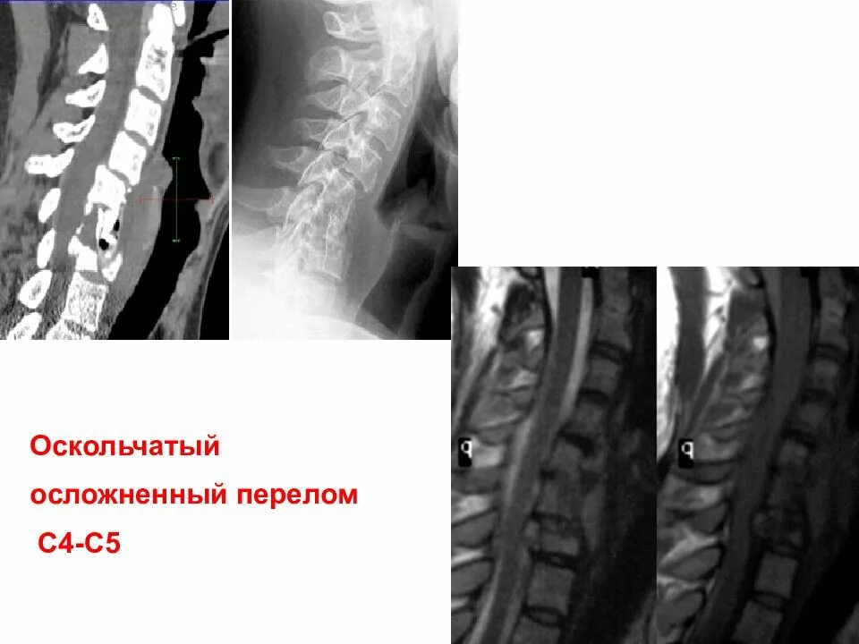 Компрессионный перелом с4 с5. Компрессионный перелом 4 позвонка. Компрессионный перелом позвоночника l1. Компрессионный перелом 5 позвоночника.