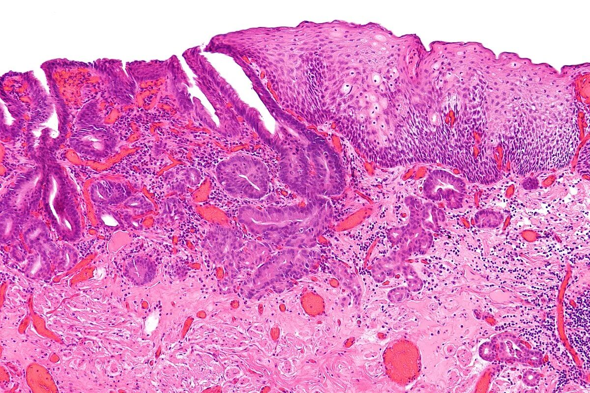 File:Endocervical adenocarcinoma in situ 2 -- intermed mag.jpg - Wikimedia Commo