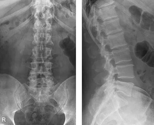 Рентген поясничного отдела позвоночника. Поясничный отдел позвоночника рентген норма. Рентген поясничного отдела позвонка. Рентген грудного отдела позвоночника. Рентгенография позвоночника в 2 х проекциях