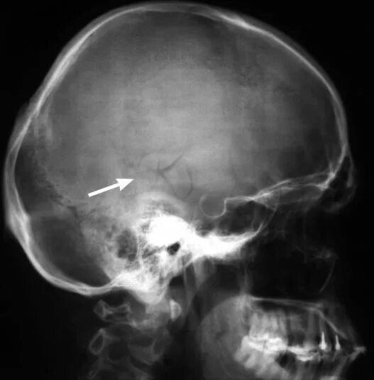 Трещина в голове. Переломы черепа рентгенограммы. Перелом височной кости рентген снимки. Перелом височной кости на рентгенограмме черепа. Импрессионный перелом черепа.