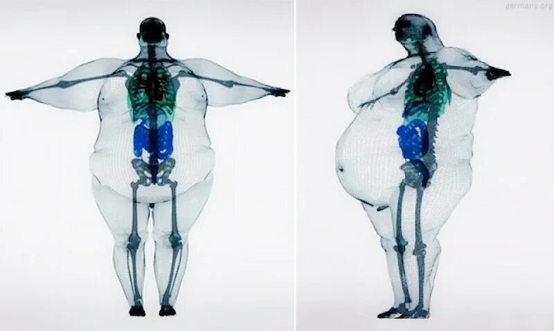 Толстый человек анатомия. Скелет Толстого человека рентген. Рентген Толстого человека кость широкая. Толстый человек рентген.