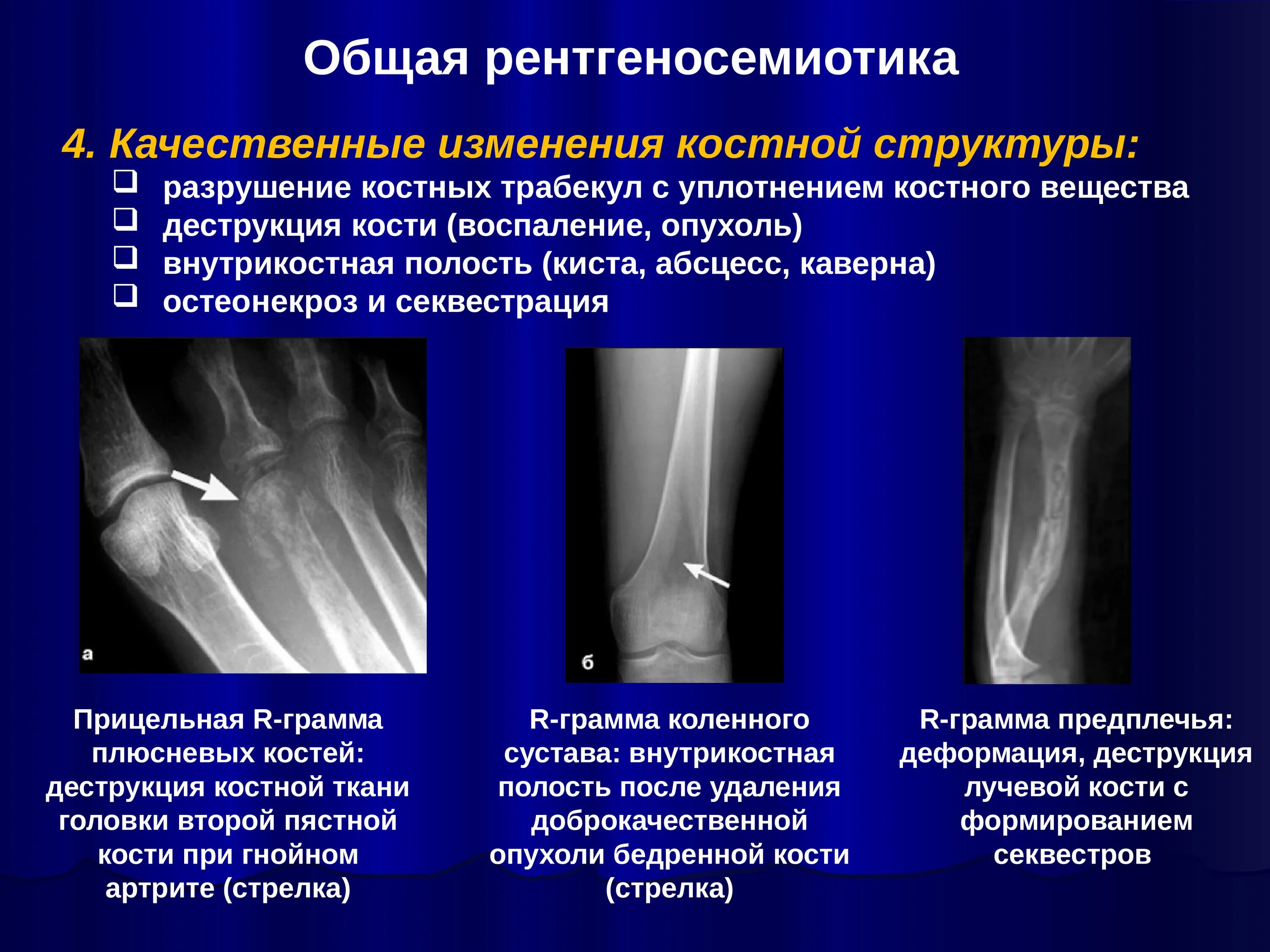 Рентгенологические синдромы костно-суставной патологии. Синдромы костно-суставной системы лучевая диагностика. Деструкция кости и остеопороз. Лучевые синдромы костей. Изменение структуры кости