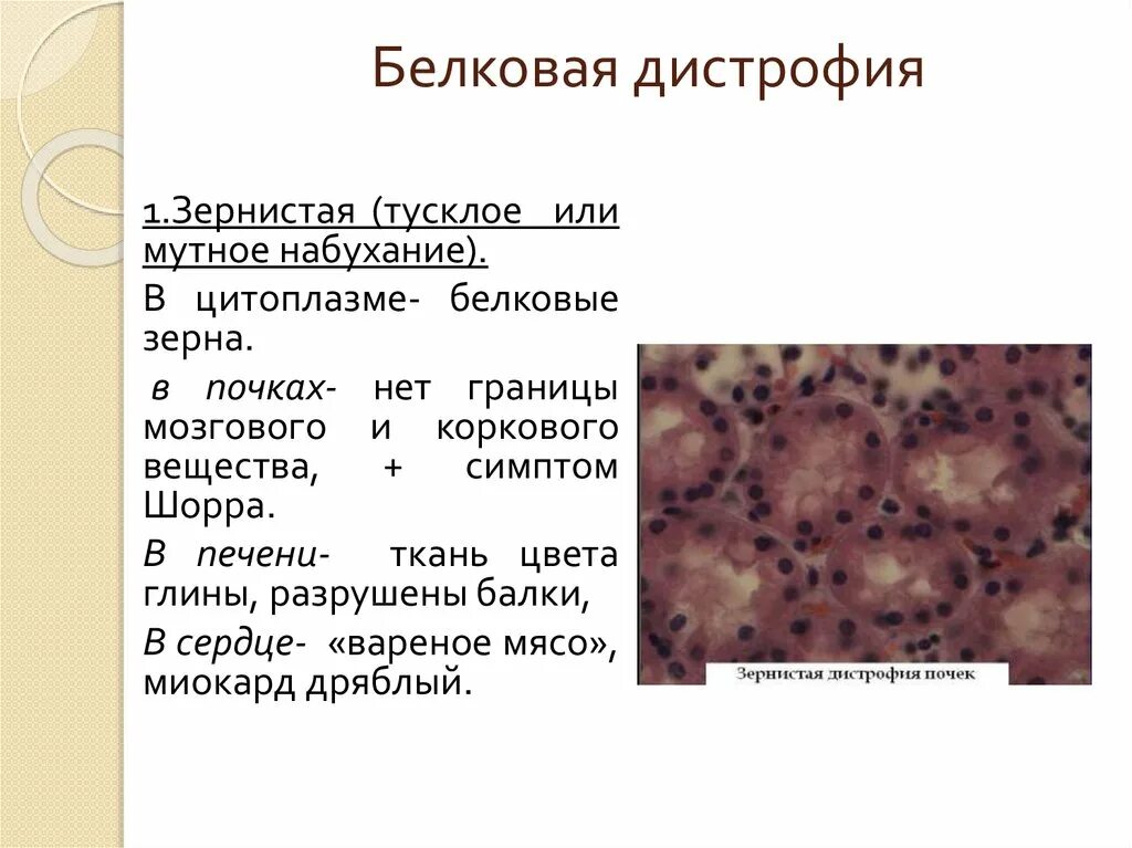 Дистрофия латынь. Зернистая дистрофия микро. Зернистая паренхиматозная дистрофия. Зернистая белковая дистрофия. Зернистая дистрофия микроскопия.