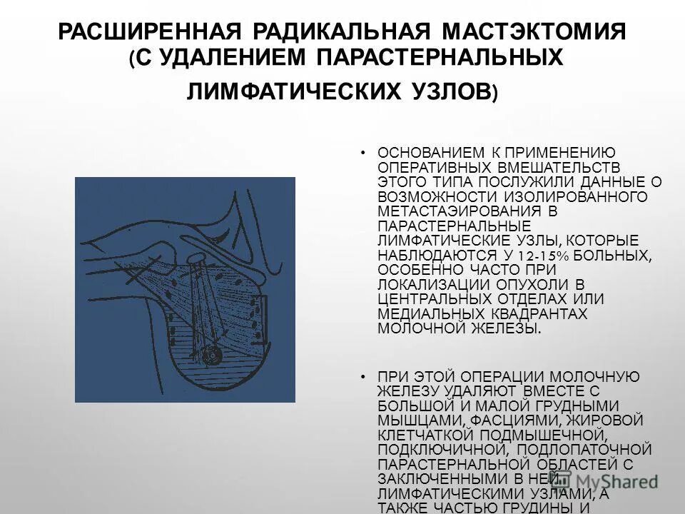 Ампутация молочной железы. Удаление узлов молочной железы. Аксиллярные лимфоузлы подмышечные лимфоузлы. Лимфатические узлы молочной железы. Маддену радикальная мастэктомия.