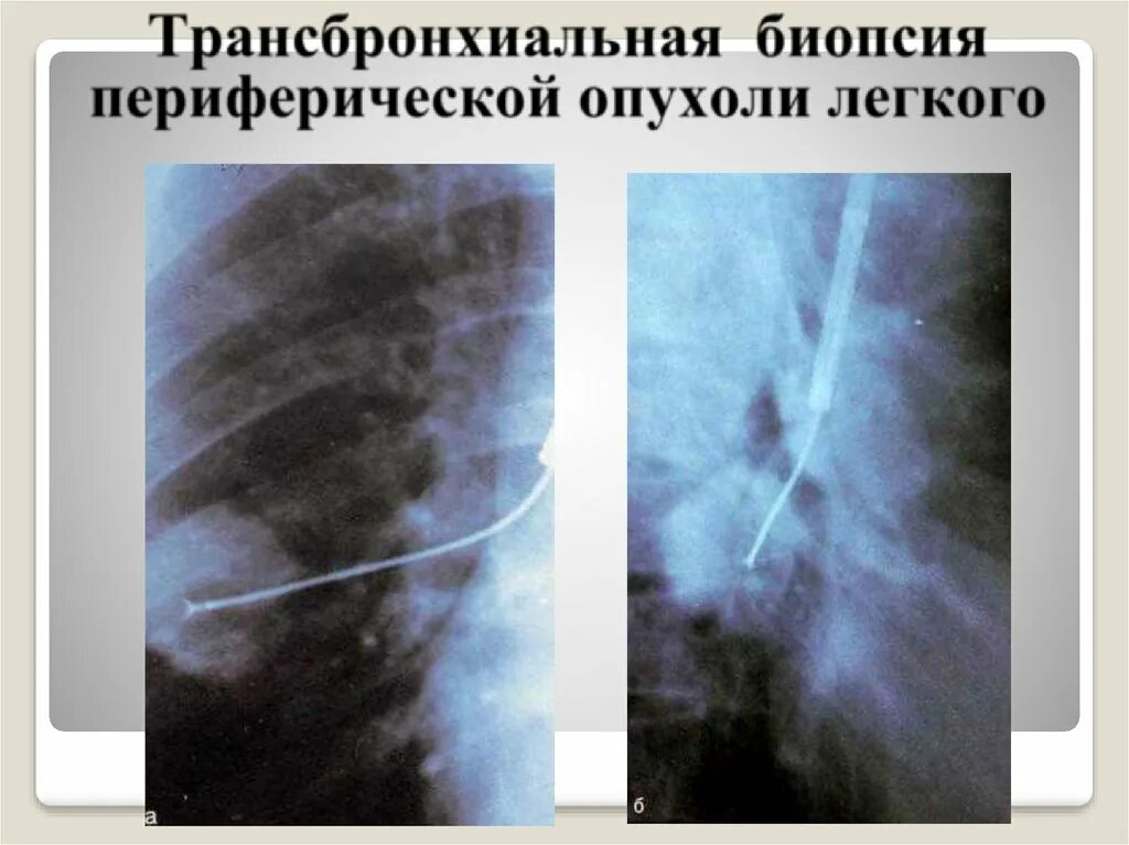 После биопсии легкого. Трансбронхиальная биопсия легких. Трансторакальная биопсия легких. Пункционная биопсия легких.