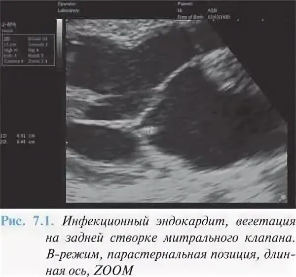 Эндокардит митрального клапана УЗИ. Эндокардит митрального клапана ЭХОКГ. Инфекционный эндокардит заключение ЭХОКГ. Вегетации на митральном клапане УЗИ. Вегетация сердца