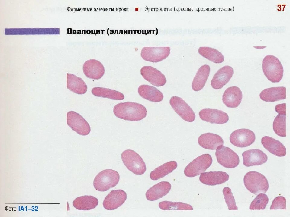 Патологические формы эритроцитов