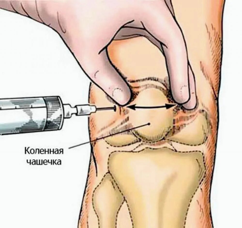 Точки пункции коленного сустава. Техника внутрисуставной инъекции в коленный сустав. Техника пункции коленного сустава топографическая анатомия. Пункция коленного сустава техника точки. Что колят для мышц