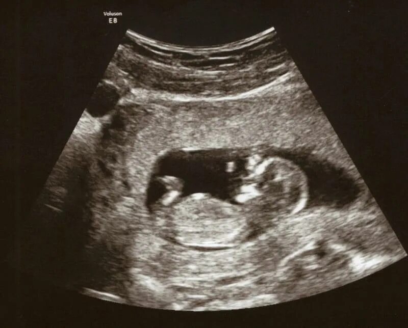 узи 12 недель беременности узи 12 недель беременности. узи 12 недель беременности мальчик или девочка. узи 12 недель беременности скрининг мальчик. как выглядит эмбрион в 12 недель. можно на 12 неделе сделать.