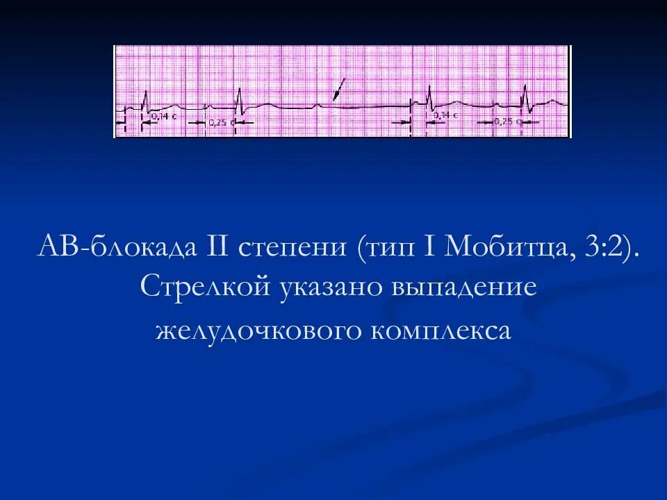 Блокады 2 степени армия. АВ блокада 2 степени 3 Тип. АВ-блокады II степени, II типа Мобитца:. АВ блокада 2 степени 2 типа. Атриовентрикулярная блокада 2 степени 3 Тип.