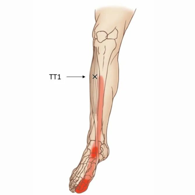 Боль в передней части голени. Триггерные точки большеберцовой мышцы голени. Большеберцовый нерв анатомия. Триггерные точки передней большеберцовой мышцы. Невропатия большеберцового.
