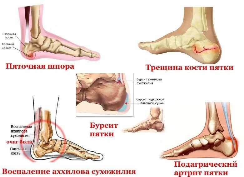 Болит стопа где подъем. Болит пятка при ходьбе сбоку. Болит пятка при наступании сбоку с наружной стороны.