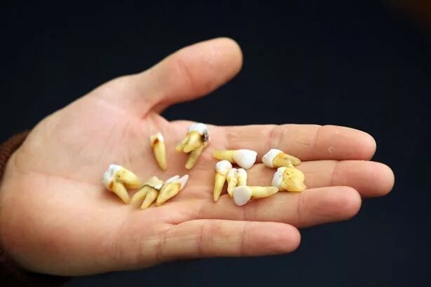 К чему снится выпавший зуб. Сонник зубы к чему снятся. К чему снятся выпавшие зубы у себя. К чему приснилось что сломался зуб. Сон вынимать зубы.