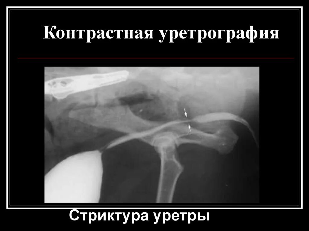 Стриктура уретры уретрография. Ятрогенные повреждения уретры. Стриктура уретры уретрограмма. Стриктура уретры рентген. Рентген анатомия уретры.