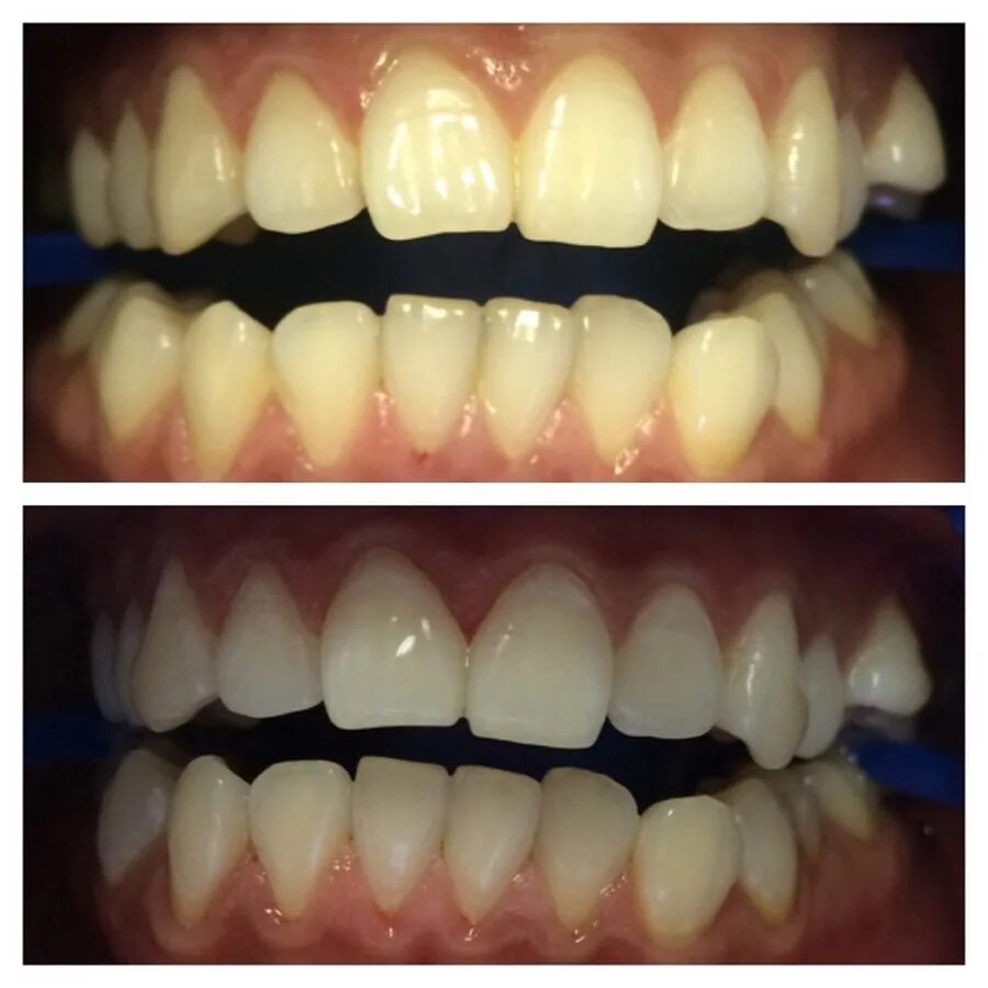 Зубы после 30. Отбеливание зубов. Отбеливание зубов до и после. Отбеливание витальных зубов. Отбеливание зубов в стоматологии до и после.