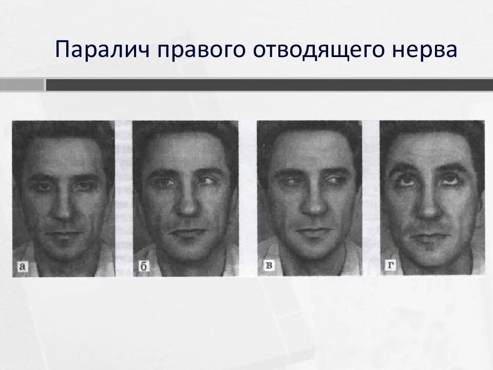 Паралич левого отводящего нерва. Симптомы поражения отводящего нерва неврология. Парез отводящего нерва глаза. Паралич глазодвигательного нерва. Паралич и парез глазодвигательного нерва.