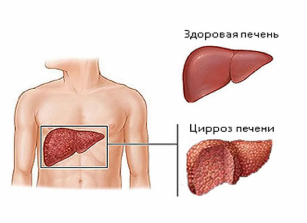 Проблема печени у женщин. Заболевание цирроз печени. Мелкоузловой цирроз печени. Клинические симптомы цирроза печени. Гепатитный цирроз печени симптомы.