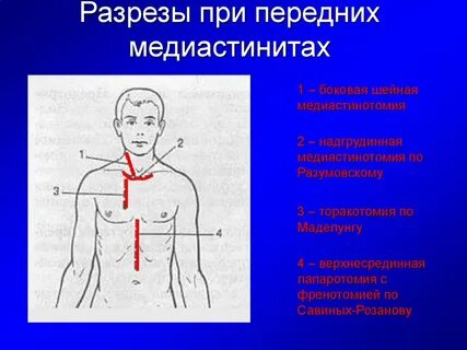 Хирургическое лечение медиастинитов