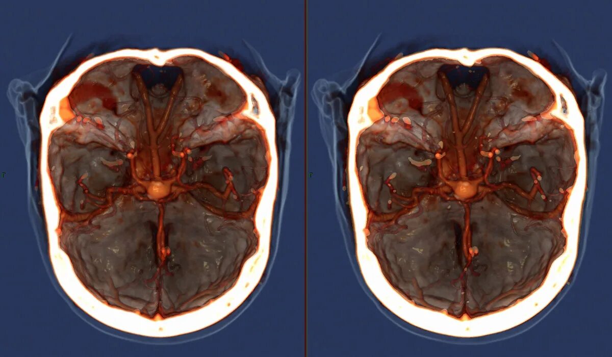 Мрт с контрастом головного. Компьютерная томография кт головного мозга. Кт головного мозга с контрастированием. Мрт головного мозга с контрастированием сосудов. Мрт или кт головного мозга с в/в контрастированием.