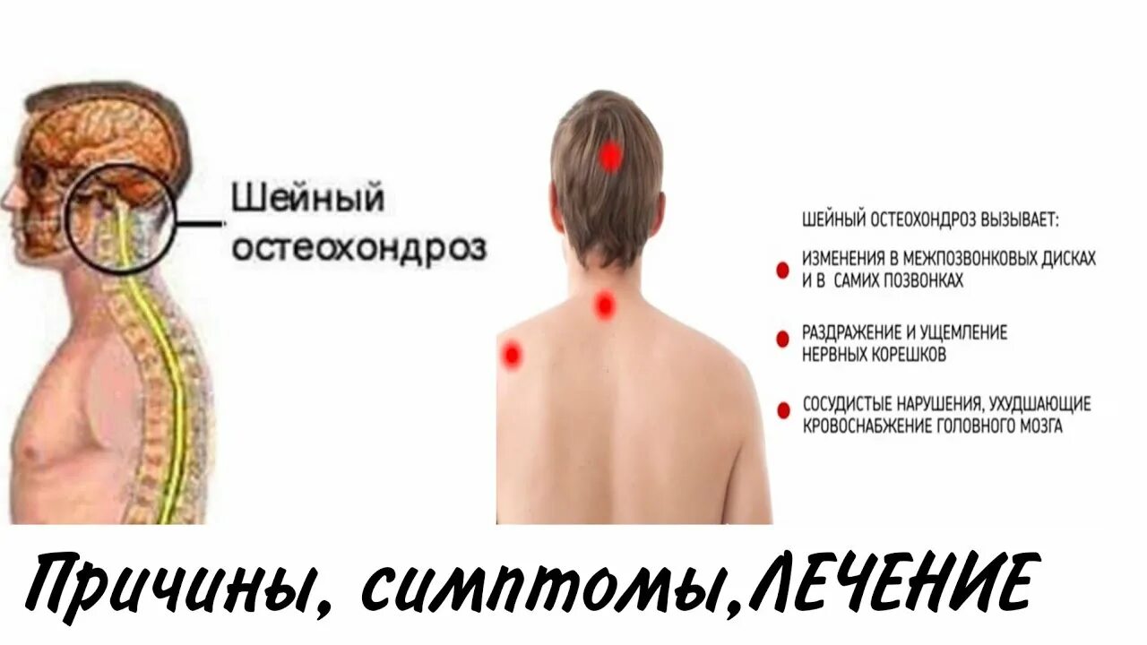 Симптомы остеохондроза у женщин форум. Остеохондроз шейного отдела симптомы. Симптомы при остеохондрозе шейного. Симптомы остеохондроза шейного отдела позвоночника. Шейный остеохондроз симптомы у женщин симптомы.