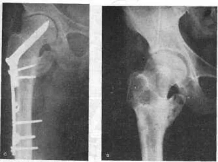 ложный сустав шейки бедра классификация. перелом бедра ложный сустав. ложный тазобедренный сустав после перелома. псевдоартроз шейки бедра. перелом бедра ложный сустав.