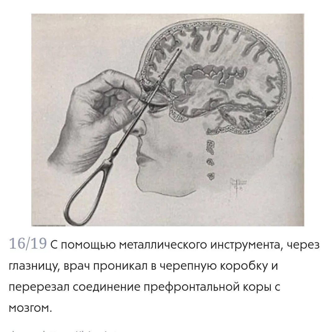 Лоботомия сейчас делают. Префронтальная лейкотомия. Трансорбитальная лейкотомия.