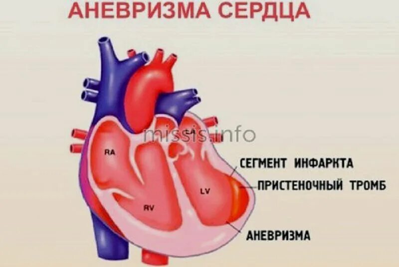 Аневризма сердца что это такое симптомы. Хроническая аневризма сердца. Стенка острой аневризмы сердца.