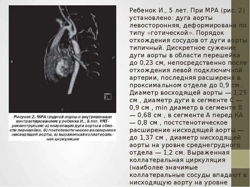 Аневризма восходящей аорты операция. Постстенотическое расширение восходящего отдела аорты. Аневризматическое расширение восходящего отдела аорты на кт. Расширение восходящего отдела аорты на кт. Аневризму восходящего отдела аорты.