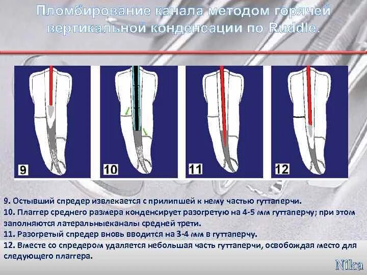 Пломбирование корневых каналов методом горячей гуттаперчи. Методики пломбирования корневых каналов гуттаперчей. Способ обтурации системы корневого канала определяется. Гибридная методика пломбирования корневых каналов. Пломбировка корневых каналов