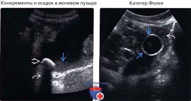 Конкременты мочевого пузыря на УЗИ. Образования мочевого пузыря на УЗИ. Катетер в мочевом пузыре на УЗИ. Сгусток в полости мочевого пузыря УЗИ.