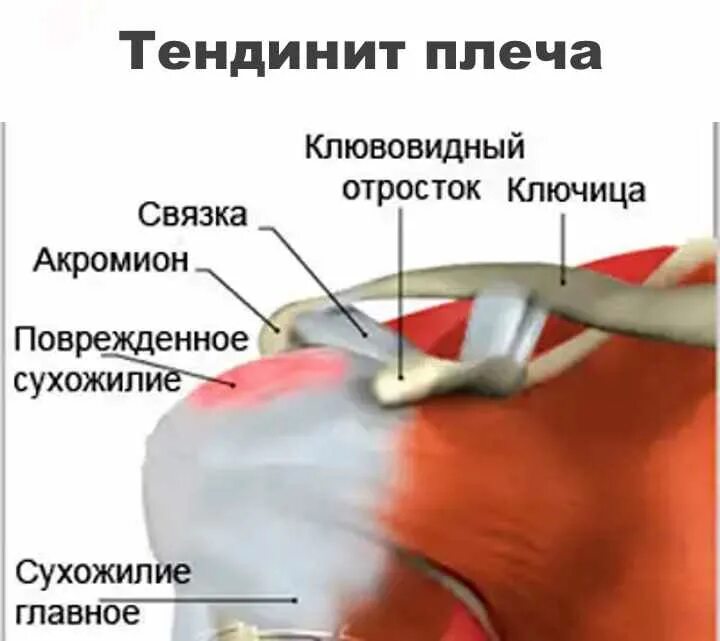 Болит плечо при поднятии. Тендинит сухожилия бицепса плечевого сустава. Воспаление сухожилия подостной мышцы. Воспаление в сухожилии надостной мышцы. Тендинопатия сухожилия надостной мышцы плечевого сустава.