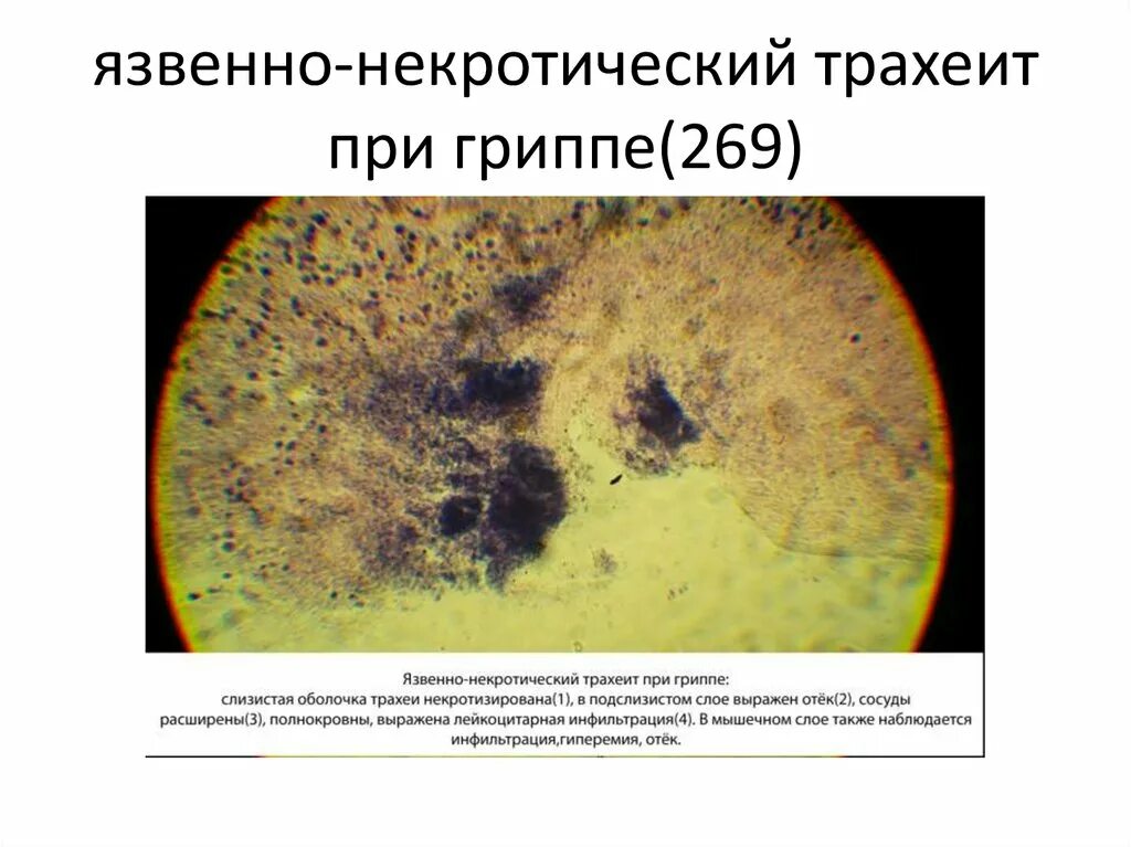 Геморрагический трахеит. Коревая пневмония патанатомия. Геморрагический трахеит. Гриппозная геморрагическая пневмония патанатомия. Хронический бронхит препарат патанатомия.