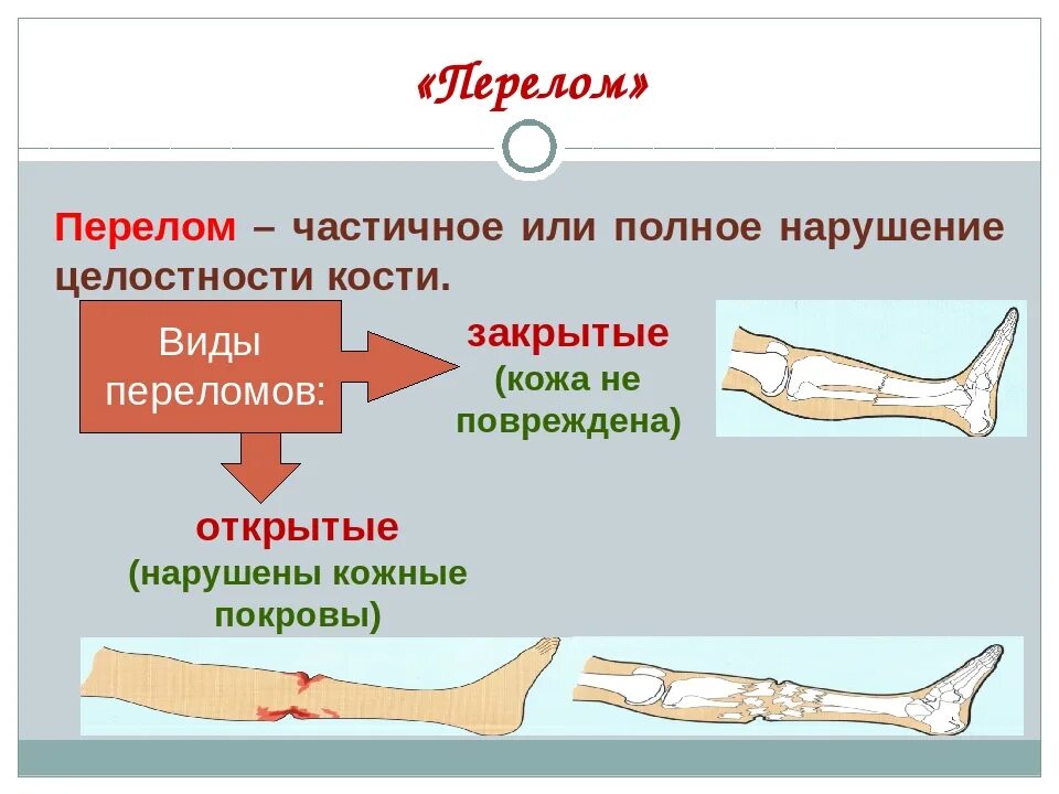 Степени открытого перелома. Перелом виды переломов признаки первая помощь. Открытые и закрытые переломы. Открытый или закрытый перелом.