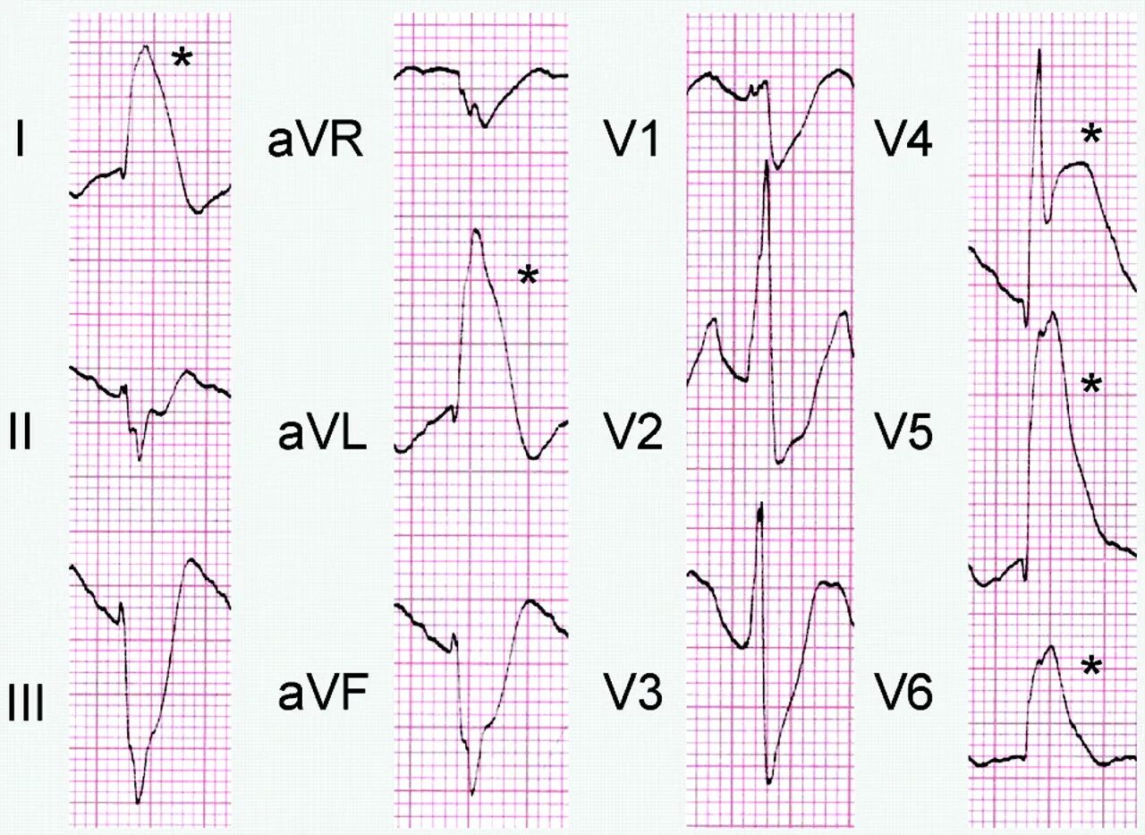Болезни на экг. ЭКГ при ишемии передней стенки миокарда. Субэндокардиальная ишемия на ЭКГ. ЭКГ при ишемических изменениях миокарда. Признаки ишемии миокарда на ЭКГ.