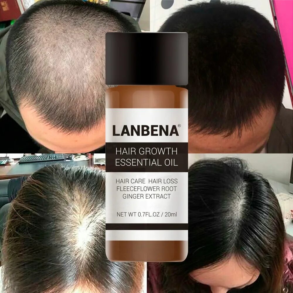 Восстановление волос роста отзывы. LANBENA hair growth Essential Oil. Масло для роста волос LANBENA hair growth Essential Oil, 20 мл. Масло для волос LANBENA hair growth Essential Oil. Сыворотка для роста волос LANBENA, 20 мл.