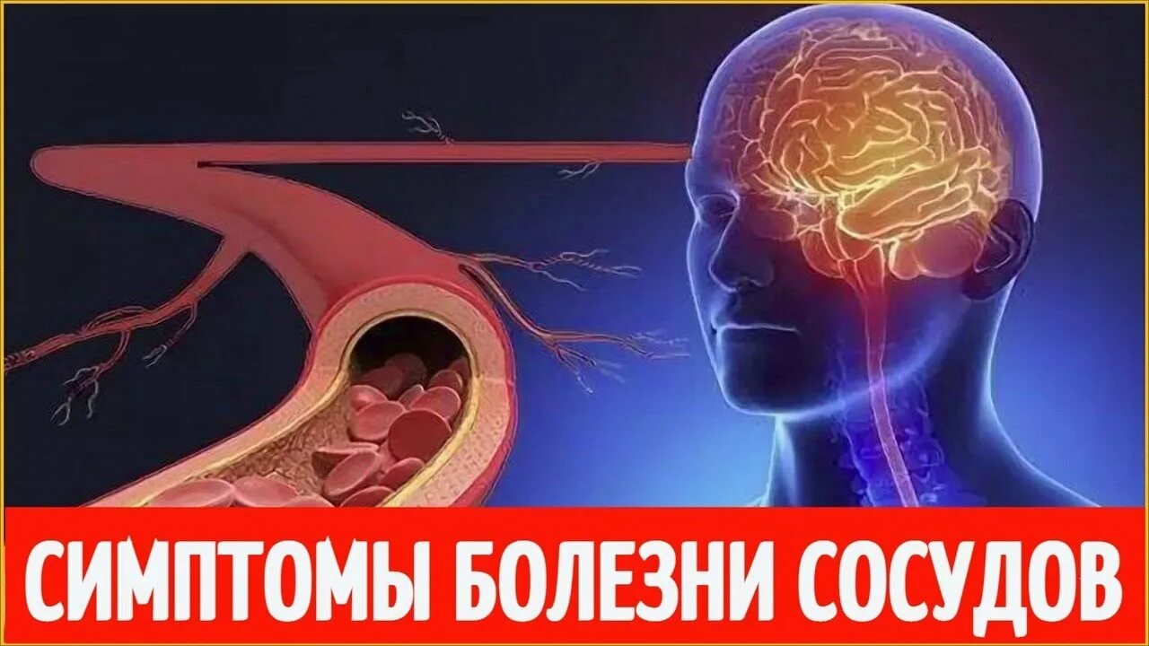 Симптомы зажатых сосудов. Болезни сосудов симптомы. сосудистые заболевания симптомы. как восстанавливаются сосуды.
