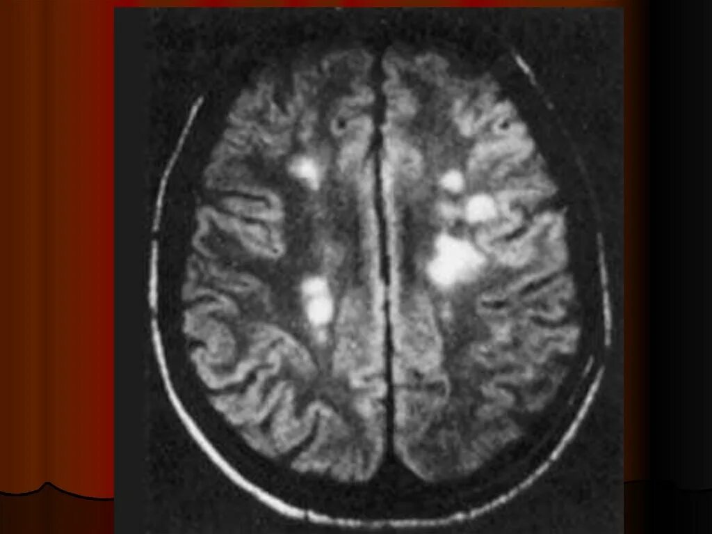 Рассеянный склероз головного мозга мрт т2 ви. Рассеянный склероз на мрт головного мозга. Лейкоэнцефалопатия неврология. Рассеянный склероз на кт. Многоочаговое поражение головного мозга
