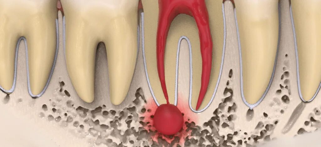 Корень зуба образований