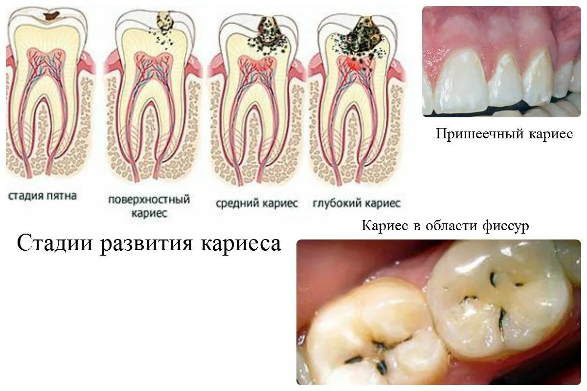 Передается ли кариес поцелуем. Классификация кариес пульпит периодонтит. Этапы кариеса пульпита. Строение зуба кариес пульпит. Кариес дентина глубокий.