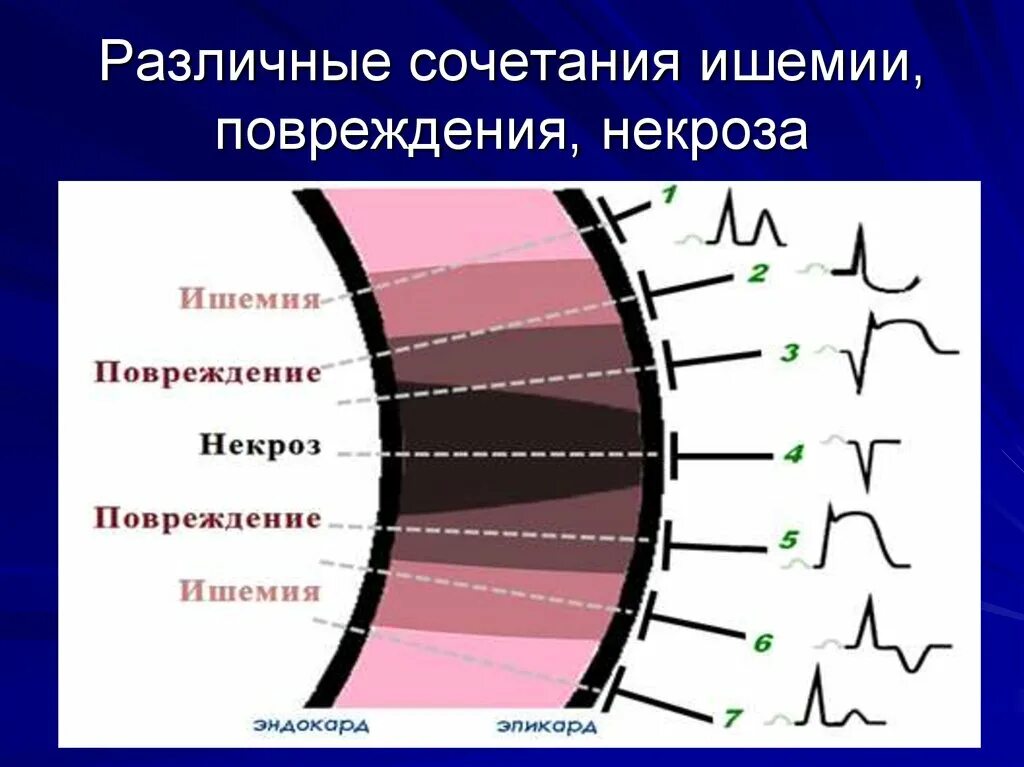 Сочетание повреждения. Ишемия миокарда на ЭКГ. Ишемия повреждение некроз на ЭКГ. Зона ишемии повреждения некроза. Ишемия ишемическое повреждение некроз.