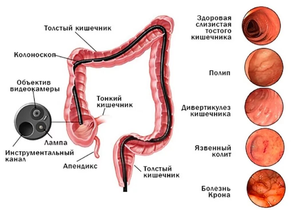 Делают ли колоноскопию без наркоза