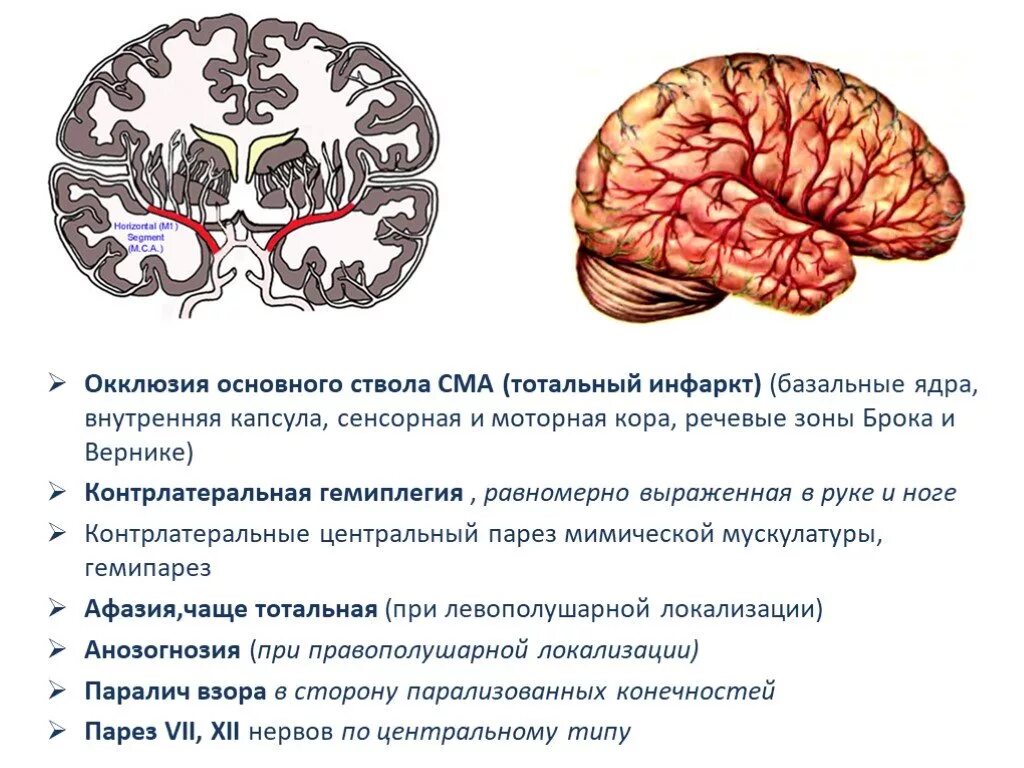 Инсульт правого бассейна. Клиника поражения средней мозговой артерии. Закупорка основного ствола средней мозговой артерии. Зоны кровоснабжения головного мозга. Симптомы поражения средней мозговой артерии.