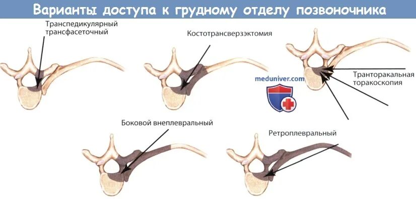 Операция на грудном отделе позвоночника. Операция по удалению грыжи грудного отдела. Малоинвазивная операция грыжи позвоночника. Торакоскопическая хирургия позвоночника.