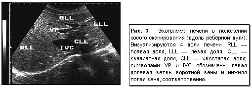 Сегменты печени на УЗИ схема. Измерение левой доли печени на УЗИ. КВР печени УЗИ. Норма левой доли печени на УЗИ. Толщина доли печени норма